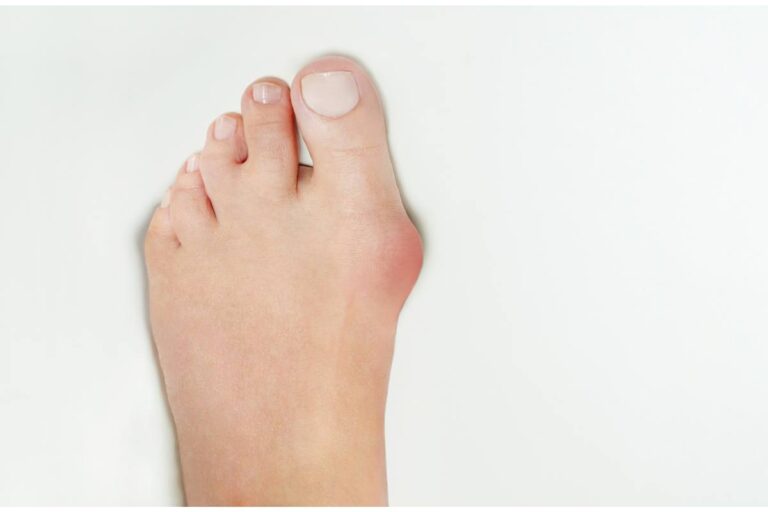 Close-up of a left foot with a bunion on the big toe against a white background.