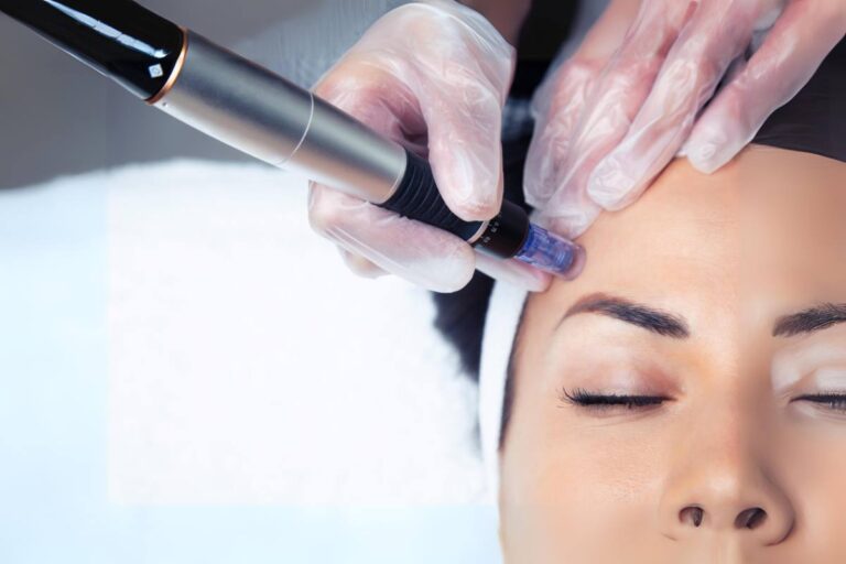 A person receiving a professional microneedling treatment on their forehead with a derma pen.