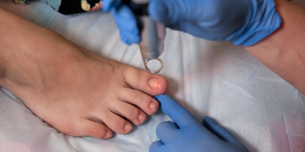 A child's foot receiving medical attention with a device on the toenail, while a healthcare professional in blue gloves holds the foot.